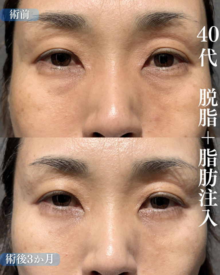40代女性　脱脂+脂肪注入